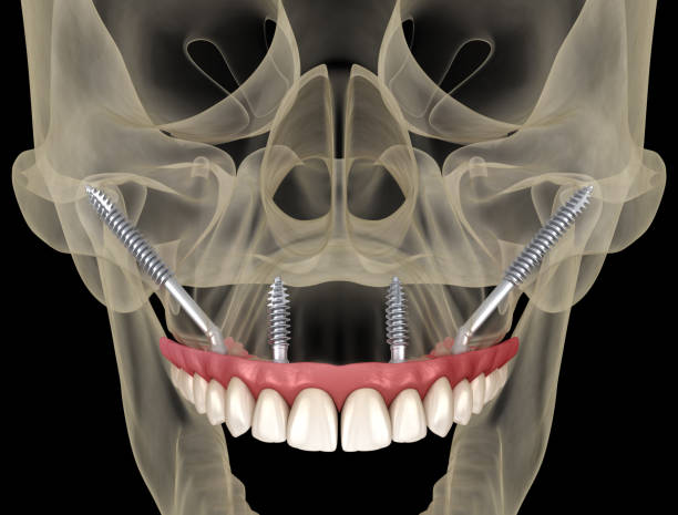 Zygoma implantati - fiksni zubi bez kosti Orto Nova